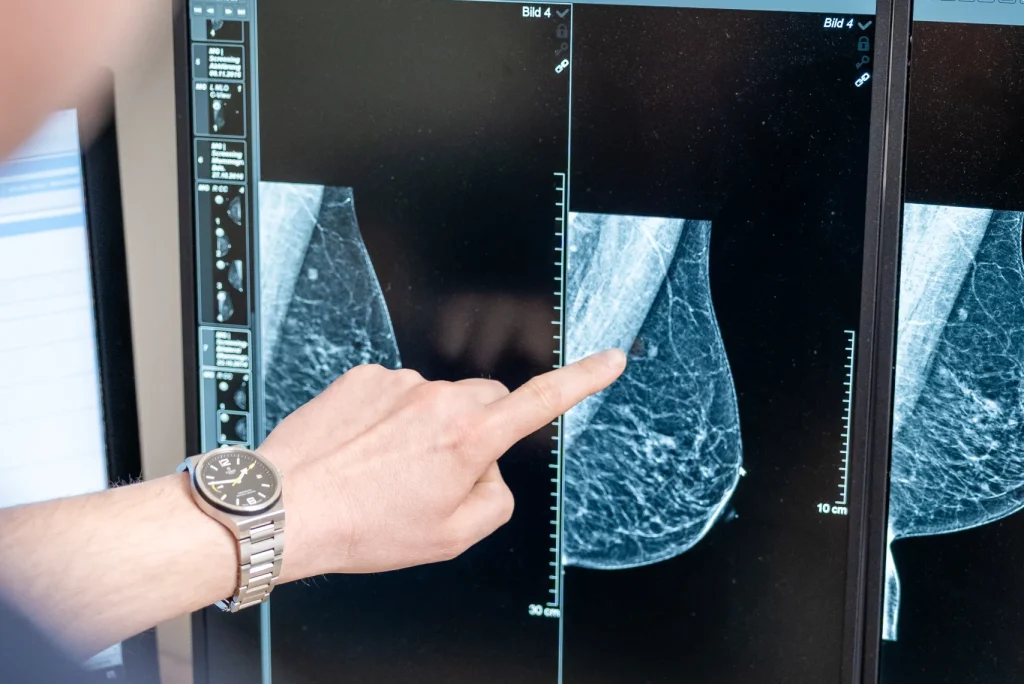 Finger zeigt auf digitale Mammographieaufnahme